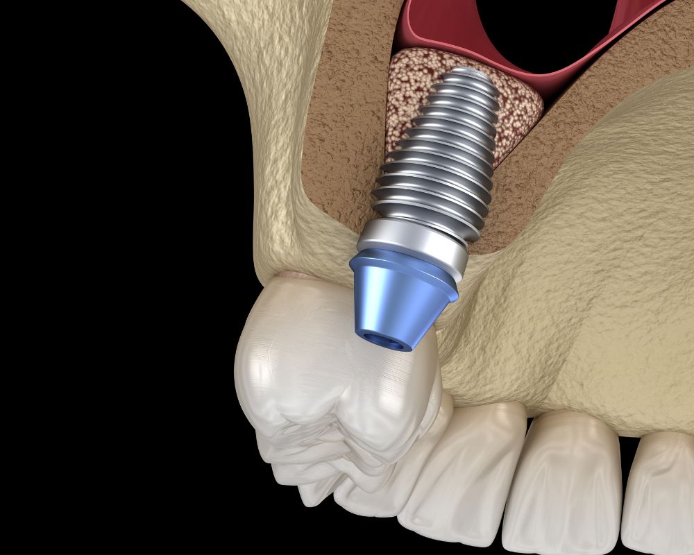 Dr Pichault Aline Oberhausbergen - sinus lift